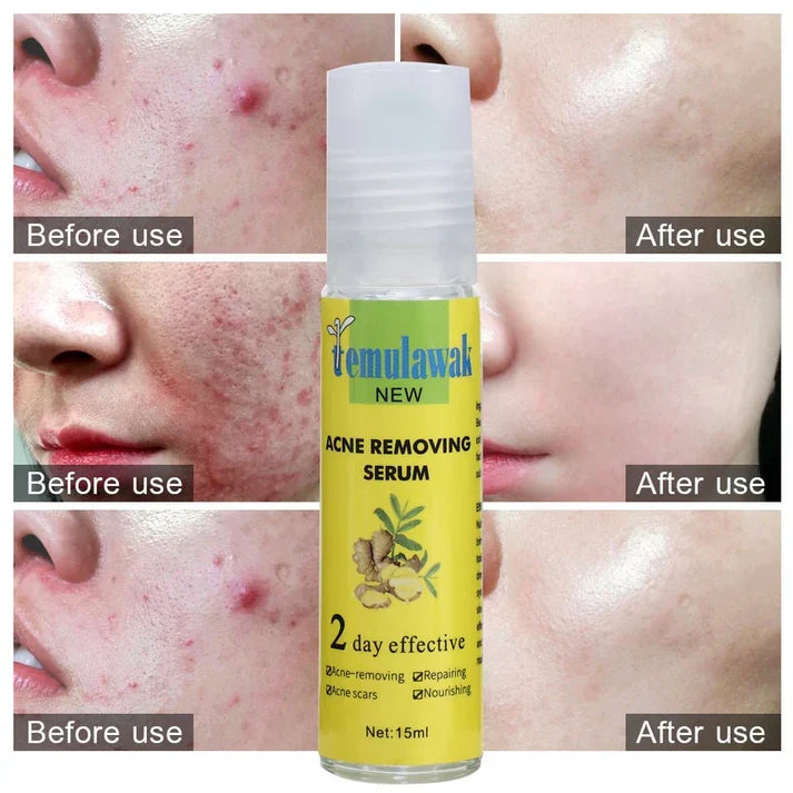 Temulawak Acne Removing Serum (Original) – Blemish & Scar Treatment