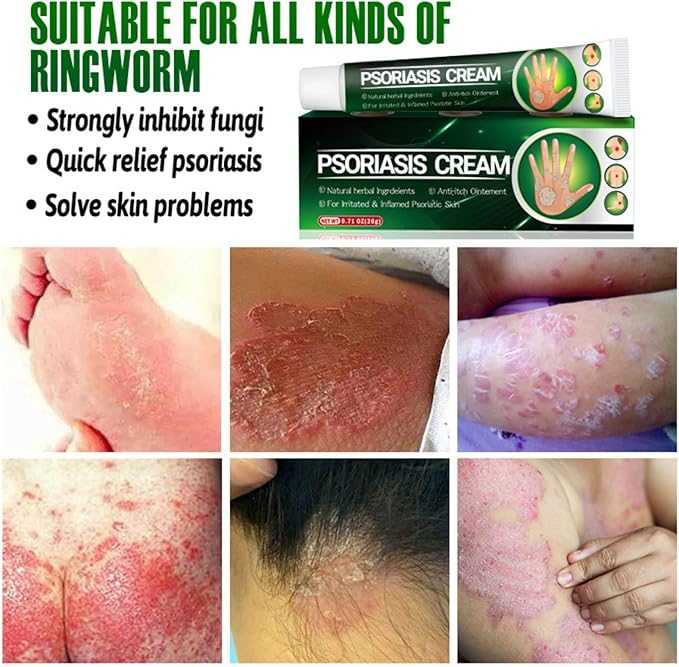 Psoriasis Relief Cream – Herbal Plant Extract Soothing Formula