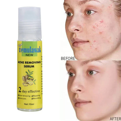 Temulawak Acne Removing Serum (Original) – Blemish &amp; Scar Treatment