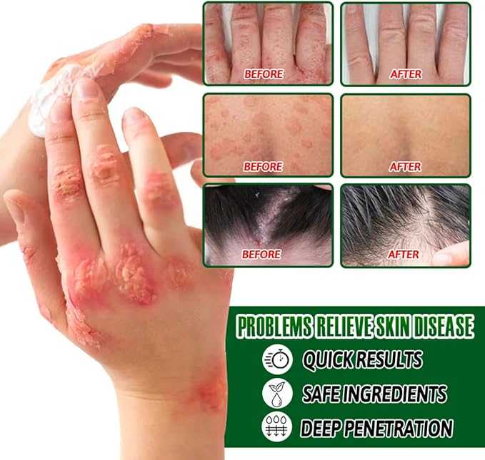 Psoriasis Relief Cream – Herbal Plant Extract Soothing Formula