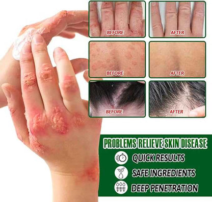 Psoriasis Relief Cream – Herbal Plant Extract Soothing Formula