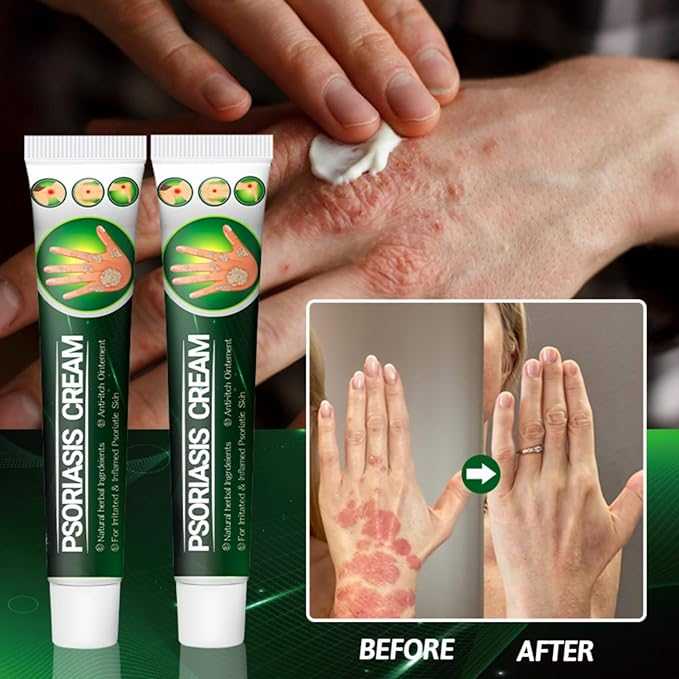 Psoriasis Relief Cream – Herbal Plant Extract Soothing Formula