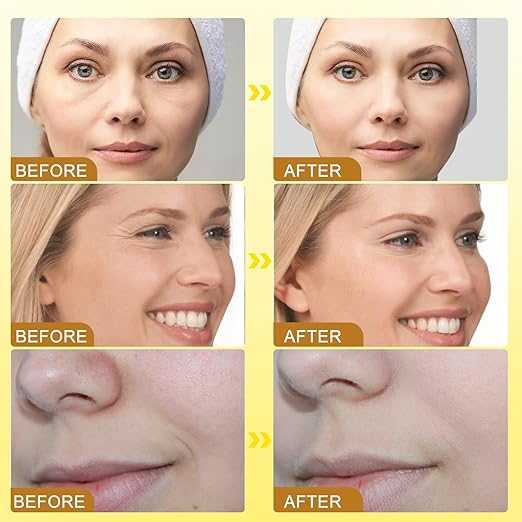Botox Bee Venom Cream – Anti-Aging Wrinkle Reduction Cream