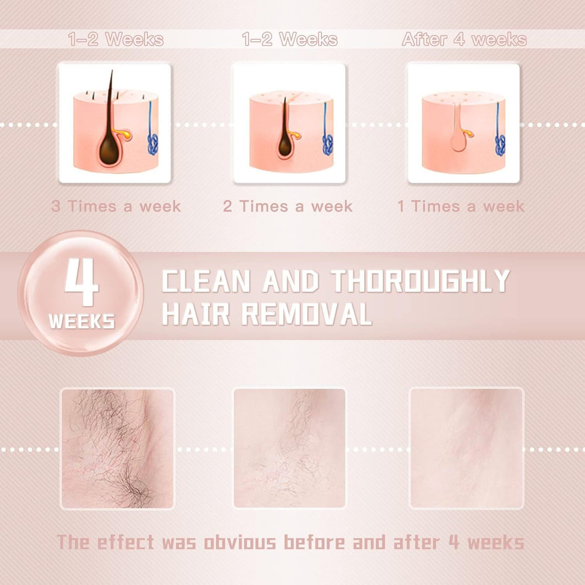 IPL Laser Hair Removal Device – For Women &amp; Men