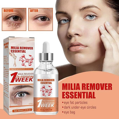 Smooth Milia Remover Serum 30ml – Clear Skin Treatment