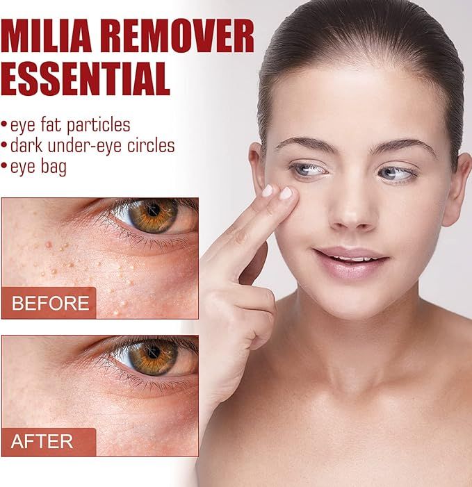 Smooth Milia Remover Serum 30ml – Clear Skin Treatment