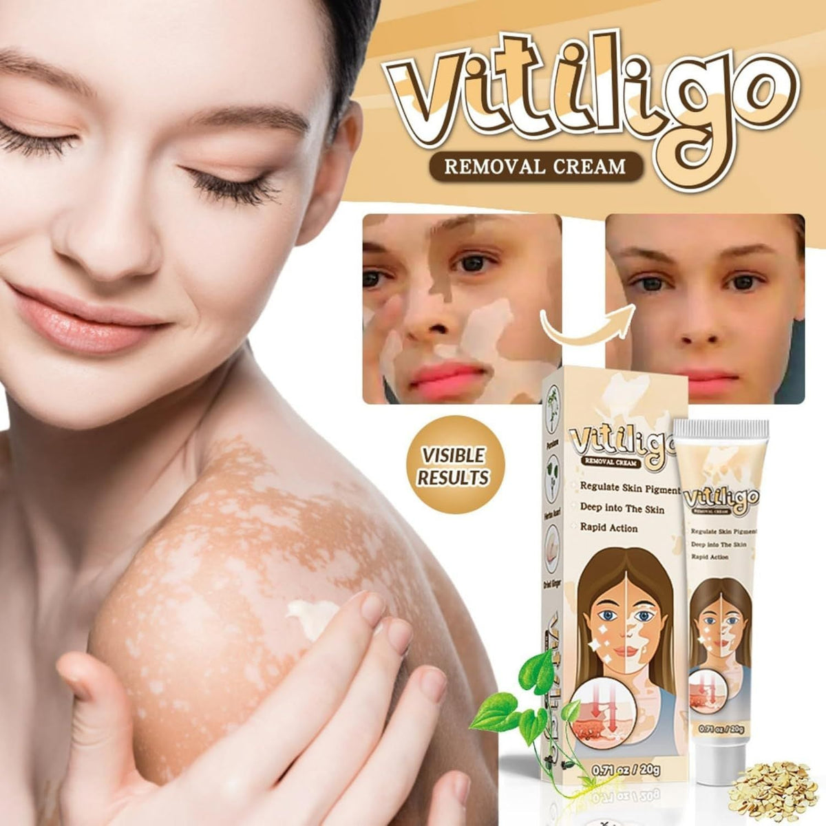 Vitiligo Removal Cream – Skin Tone Correcting Treatment